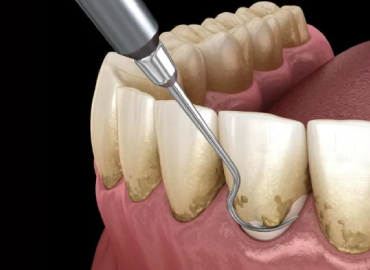 Deep Cleaning (Scaling & Root Planing)